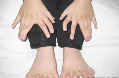 世界上手指脚趾最多的人 印度男孩34根破纪录 手14脚20