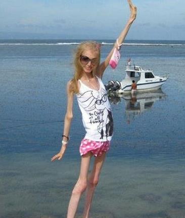 世界上最瘦的女人Kseniya Bubenko，身高158厘米体重20公斤