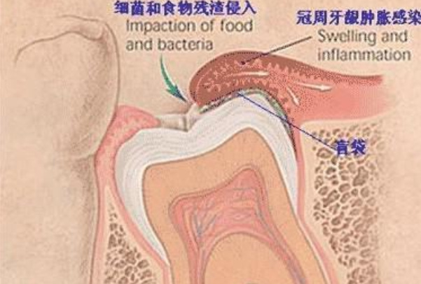 智齿从哪里长出来的：牙弓最靠里的位置(成年后生长)