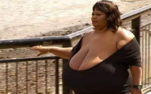 世界上最大的天然乳房 安妮·霍金斯·特纳双乳重达38.5公斤