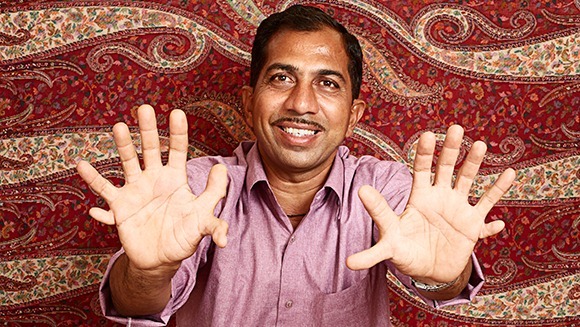 手指头最多的人 印度男子共有28根手指和脚趾创纪录