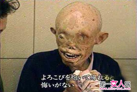 广岛幸存者的现在的照片，为什么广岛长崎核爆还能住人？
