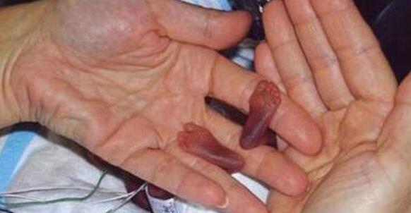 存活下来世界最小早产儿，出生时仅280克，24厘米长