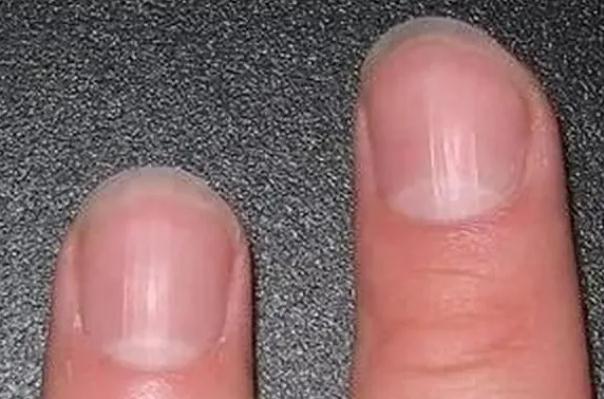 灰指甲的坏处有哪些？灰指甲对女性的危害有哪些？