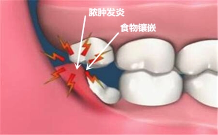 牙菌斑以及食物残渣等容易对拔智齿的创口造成感染。</p><p>