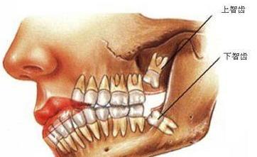 智齿发炎疼痛为什么不能立刻拔掉 智齿一定要拔吗(多图片)