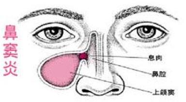 鼻窦炎是由什么原因引起的？鼻窦炎中西医的最好治疗方法