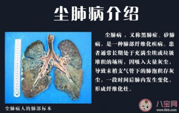 尘肺病到底有多严重 尘肺病如何预防