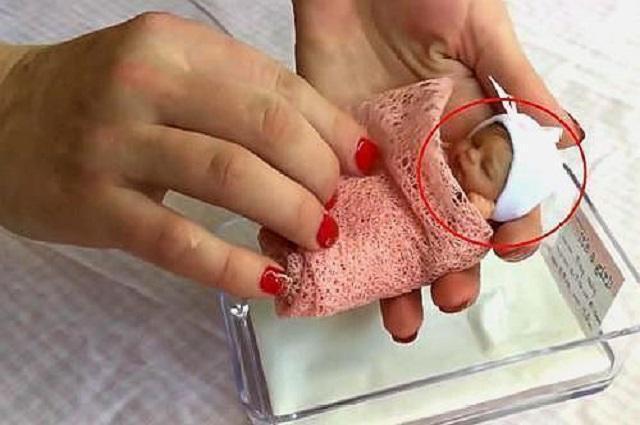 世界上最小的婴儿22周出生那个出生体重仅0.56斤的世界最小婴儿6