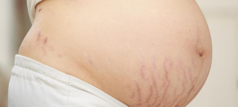 肚子长妊娠纹的4个信号 妊娠纹重要都长在什么地方