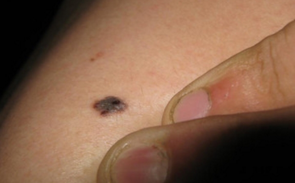 黑痣癌变的征兆黑痣癌变的征兆是什么？1