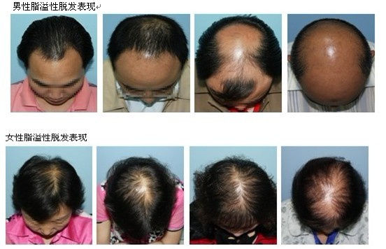 脂溢性脱发怎么医治最好？这儿有方法！【建议收藏】是怎么回事？