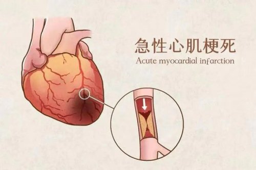 睡觉时若出现5个症状要及时排查病因小心心梗来临