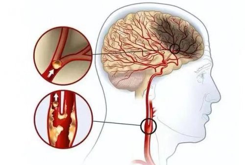 体检发现颈动脉斑离脑梗还有多远